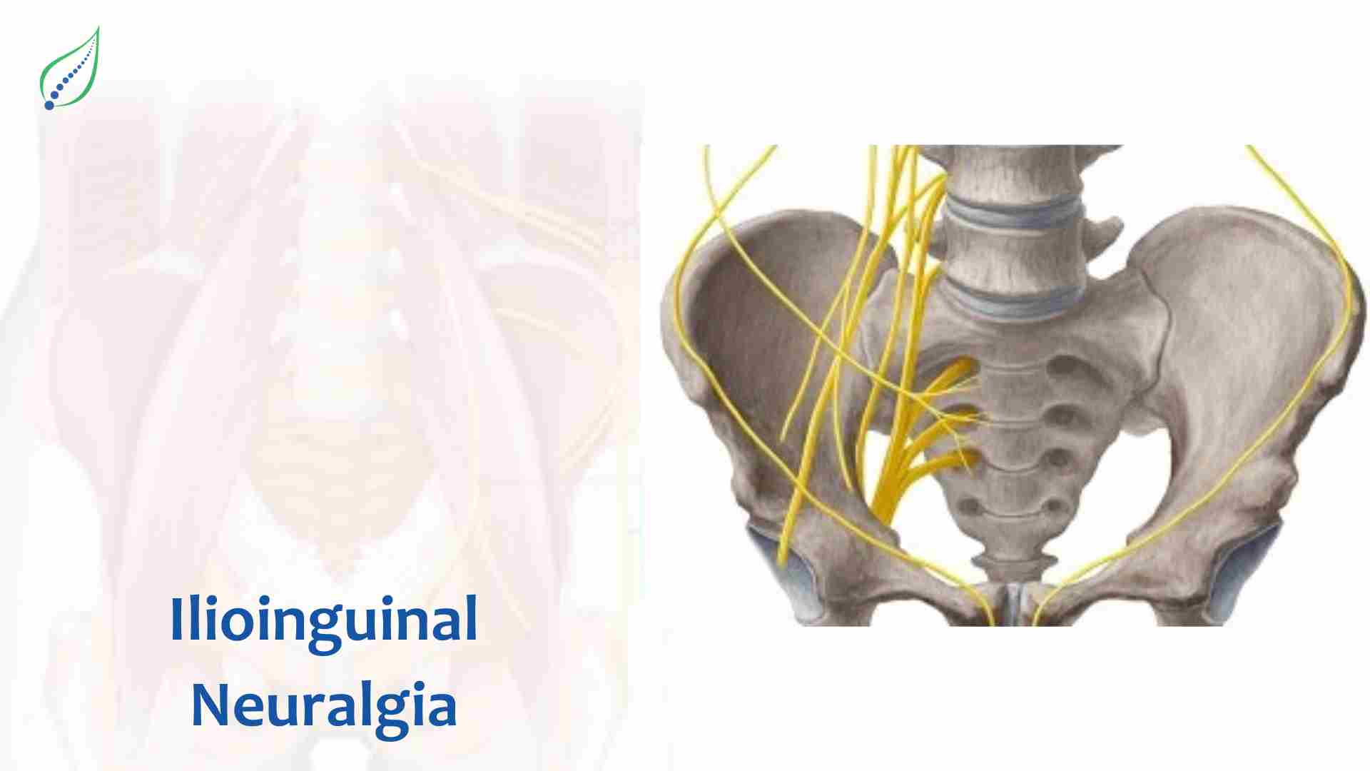 Understanding and Managing Ilioinguinal Neuralgia